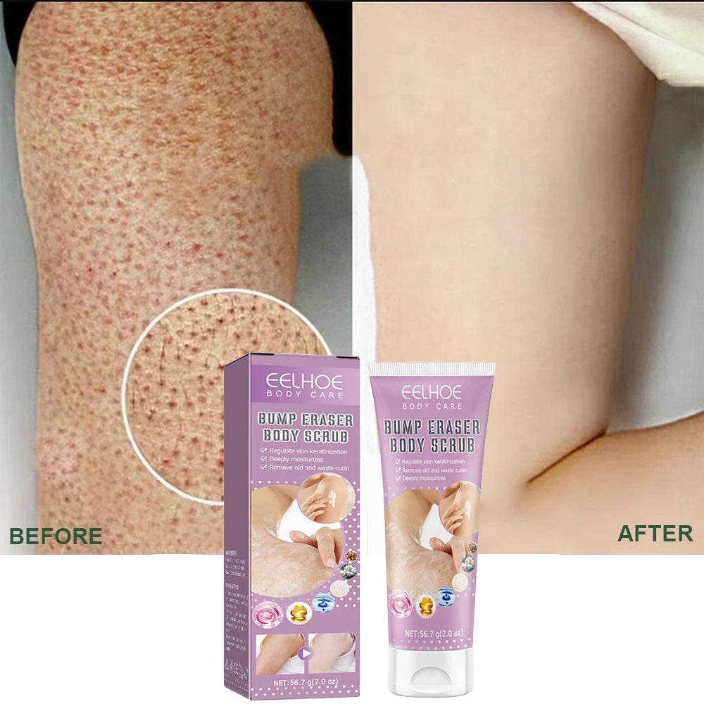 Keratosis Pilaris Cream For Strawberry Legs Removal KP Bump Eraser Dark Spots Face Body Whitening Smooth Moisturizes Skin Care