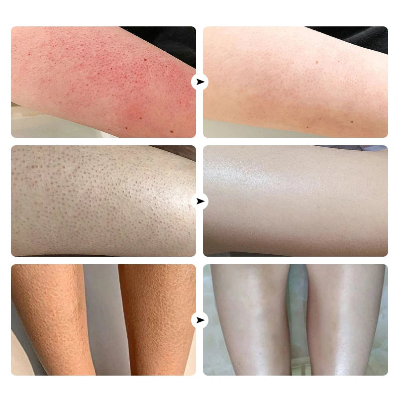 Keratosis Pilaris Cream For Strawberry Legs Removal KP Bump Eraser Dark Spots Face Body Whitening Smooth Moisturizes Skin Care