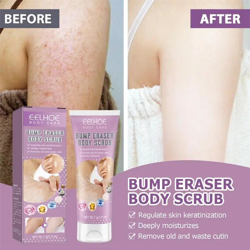 Keratosis Pilaris Cream For Strawberry Legs Removal KP Bump Eraser Dark Spots Face Body Whitening Smooth Moisturizes Skin Care